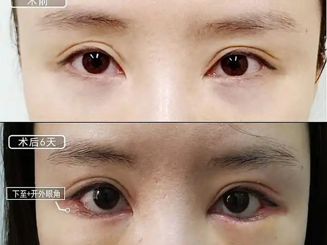 更新一个下至开外眼角的案例