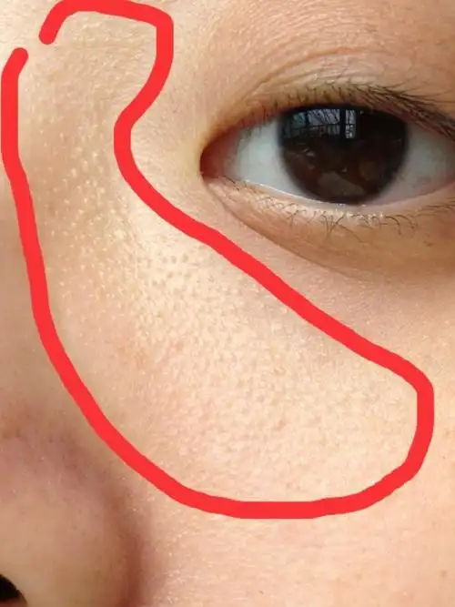 脸上长图片上的痘痘是不是闭口,怎么治