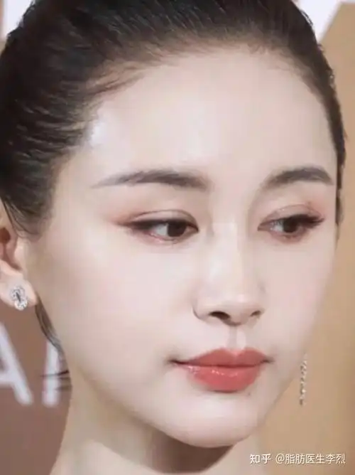 王子文面部填充大变活人实现逆龄神话