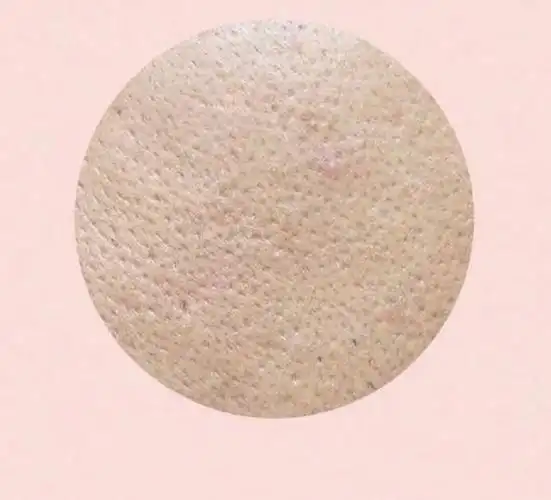 毛孔粗大也分很多种,快看自己是属于哪种毛孔粗大吧~|角质|胶原蛋白