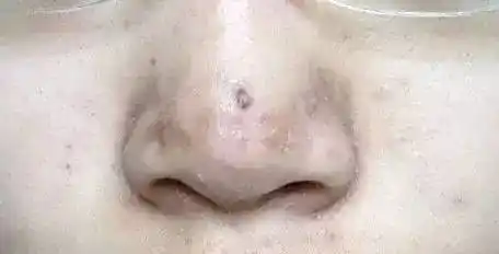 最招年轻人恨的面部问题!白头粉刺究竟是什么?