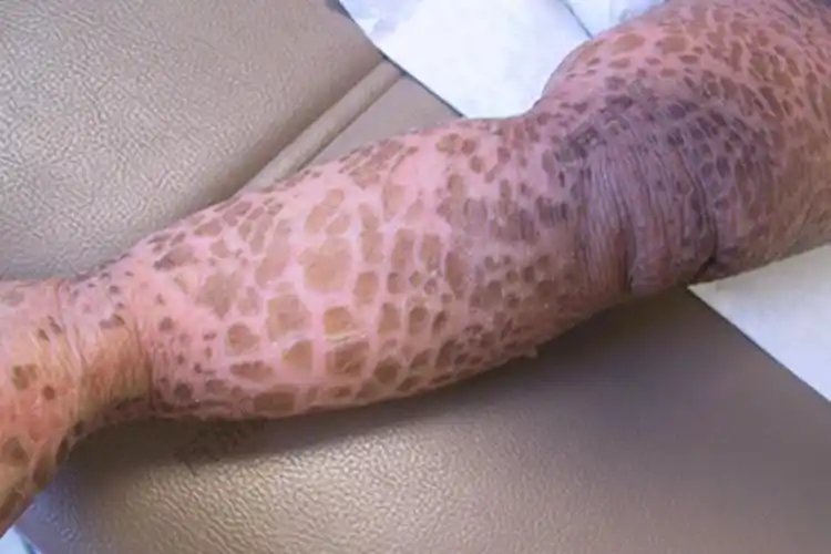 鱼鳞皮肤病症状图片_有来医生