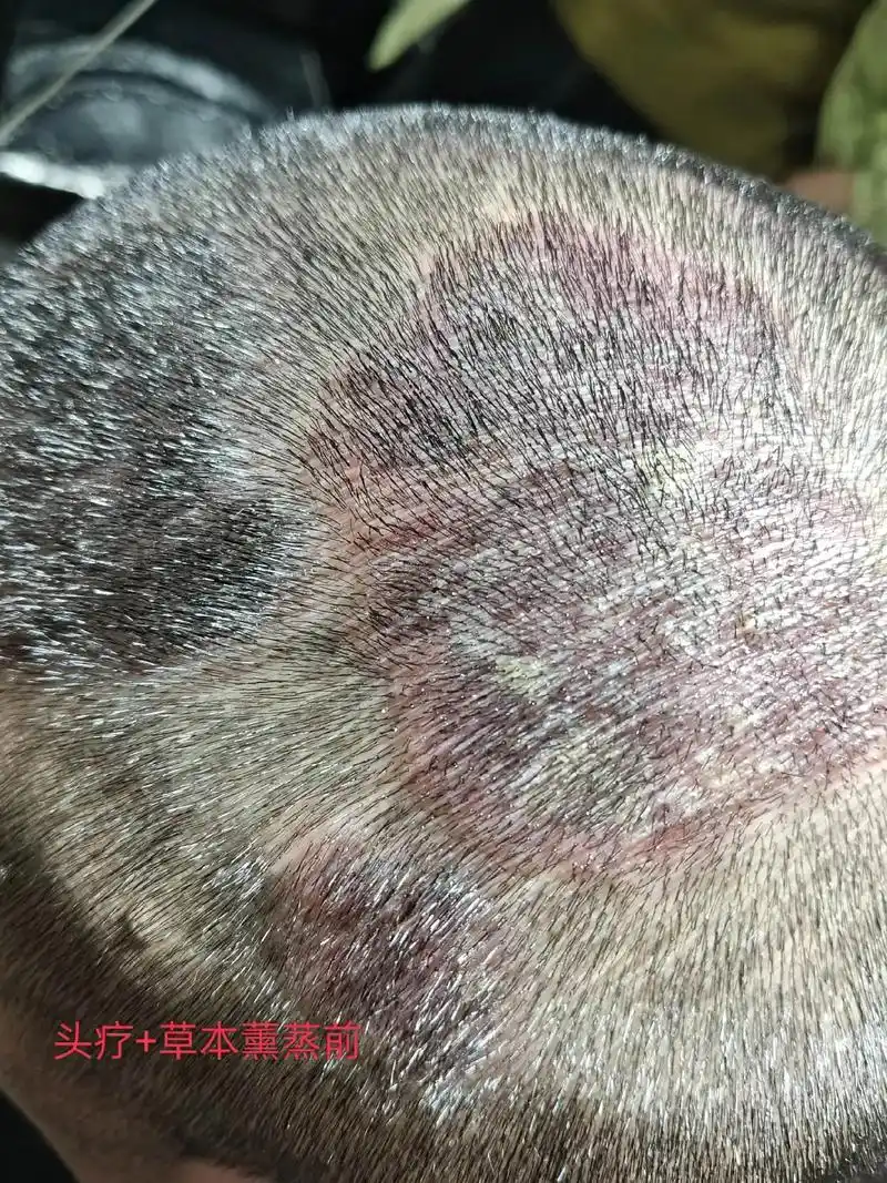 真实案例,准南胡总的客户头部严重的牛皮癣这些还没