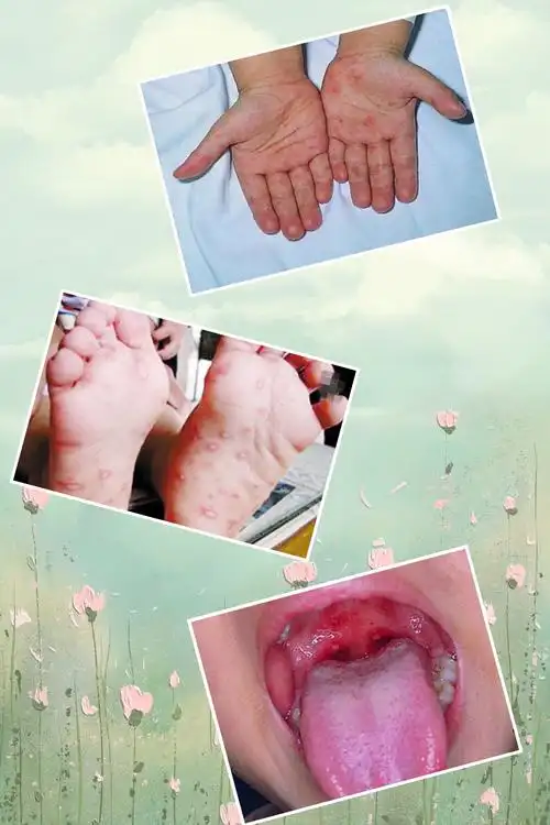 预防手足口病