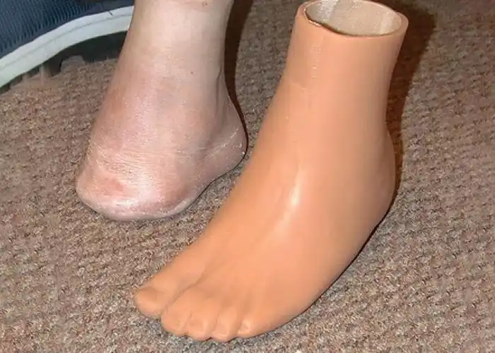 关于部分足部和脚趾截肢的知识 - 行业新闻 - 优邦假肢矫形器(上海)