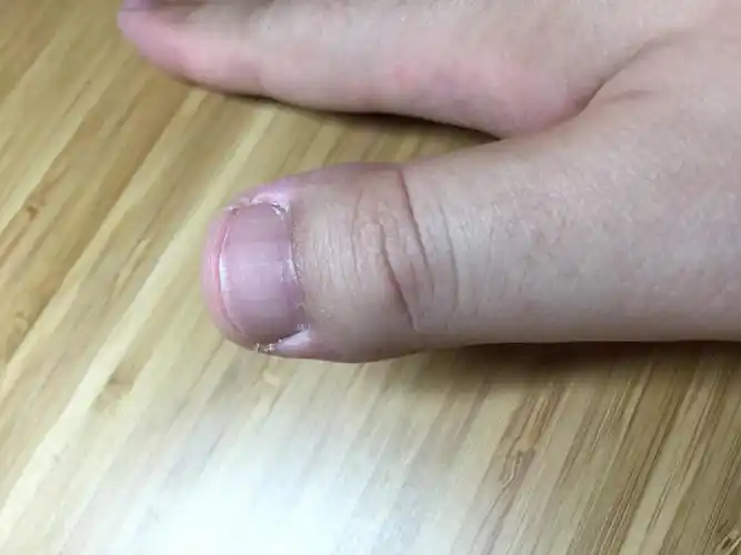 双手大拇指末端比大多数人短美甲,指甲,一截