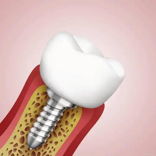 苏州种植一颗牙需要多少钱,20多岁种牙是一种什么体验?