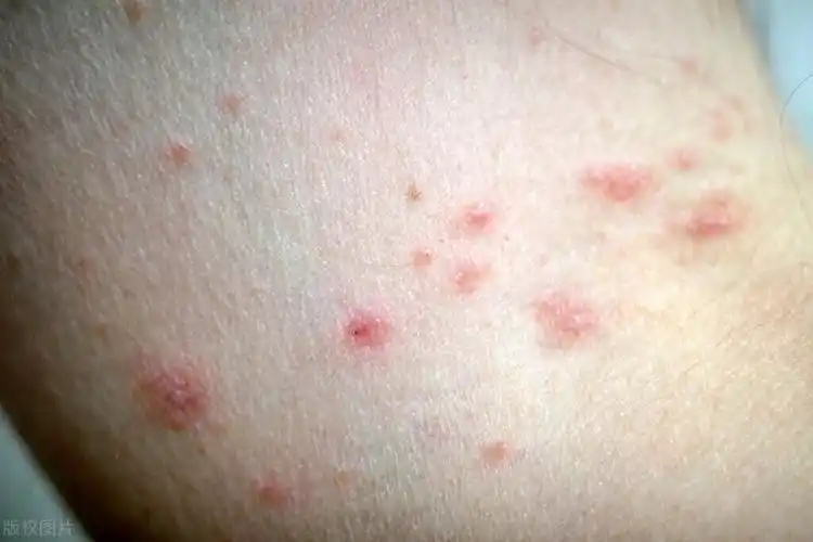 不要错把艾滋病当皮肤病,皮肤出现3种情况,可能是艾滋发出信号