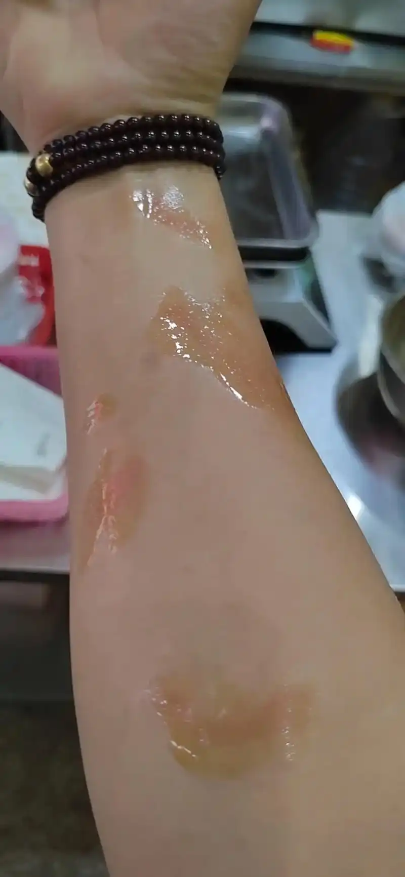 遍体鳞伤 #二十年前这只手臂开水烫伤,皮肤暗沉.现在是雪上 - 抖音