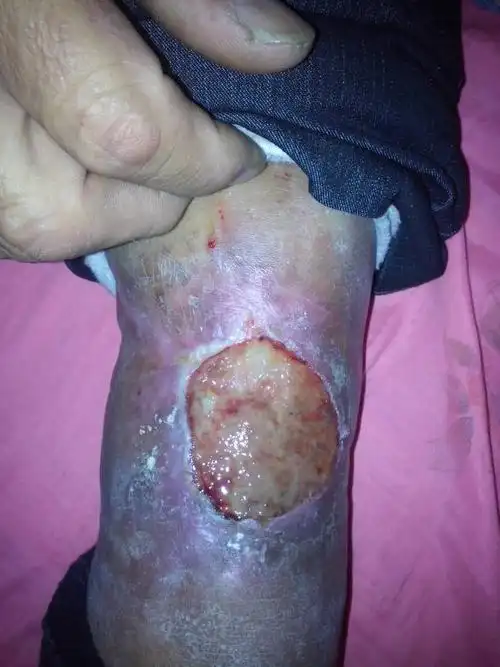 小腿伤口不愈合流黄水,外有骨折.病五年