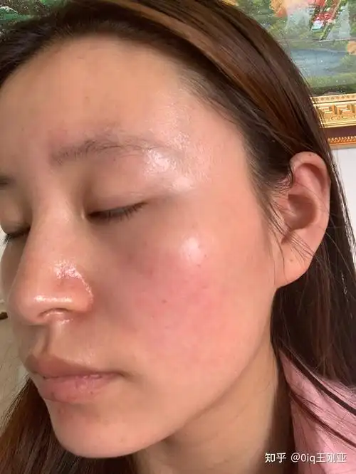 角质层薄/敏感皮肤怎么修复改善?