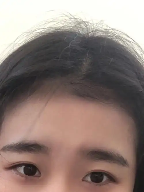 低发际线真的好烦