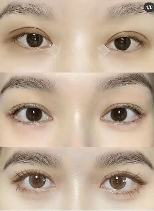 整容过的双眼皮图片大全