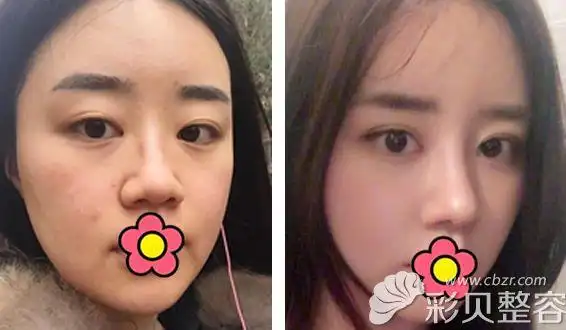 找韩国爱婷金振星院长做鼻综合隆鼻后,鼻头鼻翼缩小很多!