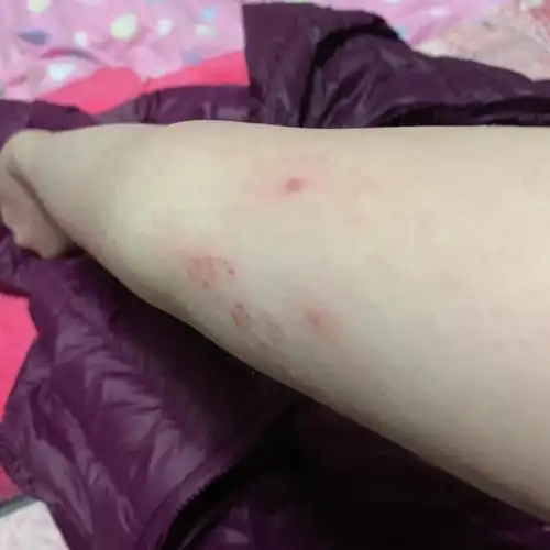 请问手上这些红点是什么?