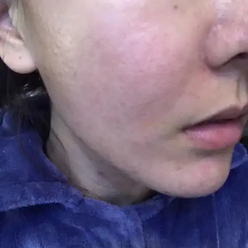 果酸换肤第一次 第二天