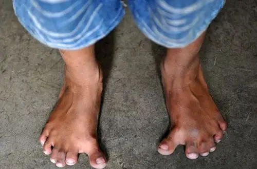 餐饮店老板娘为穿高跟鞋切脚趾 双脚天生就有六趾