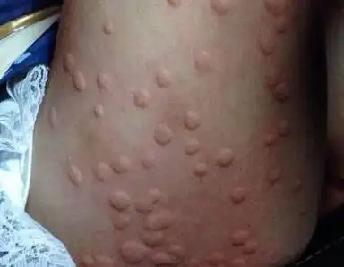 然后就杯具了,还没等蚊子吃饱他就受不了了,那满身的疙瘩好像神奇四侠