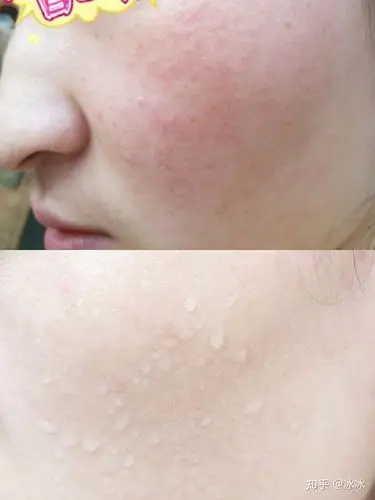 角质层薄,有修复的办法吗,有什么适合的护肤品吗?