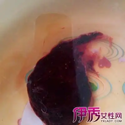 【图】一个月流产胚胎图片介绍 盘点3种常用的人流措施