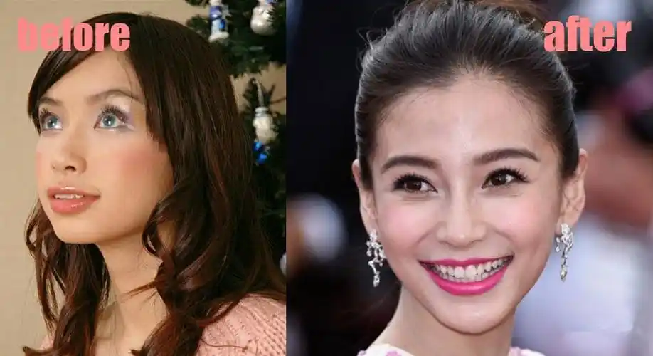 效果最明显的要属baby,baby整牙之后颌骨变动,脸型也跟着变了.