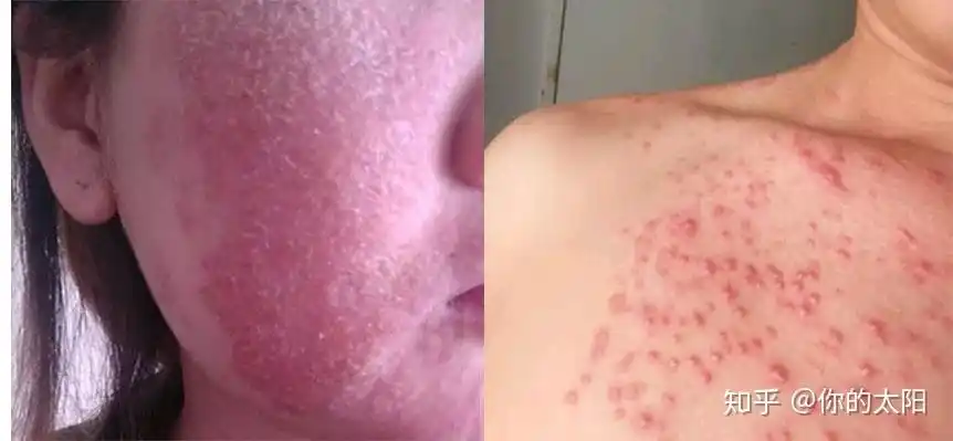 毛囊炎和脂溢性皮炎的区别是什么