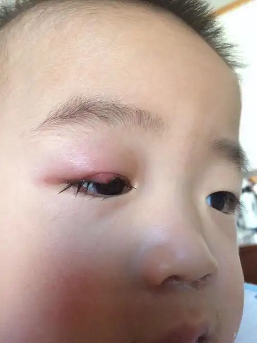 专家帮忙看看这是麦粒肿还是霰粒肿,如何治疗更好? 病人情况:年龄1.