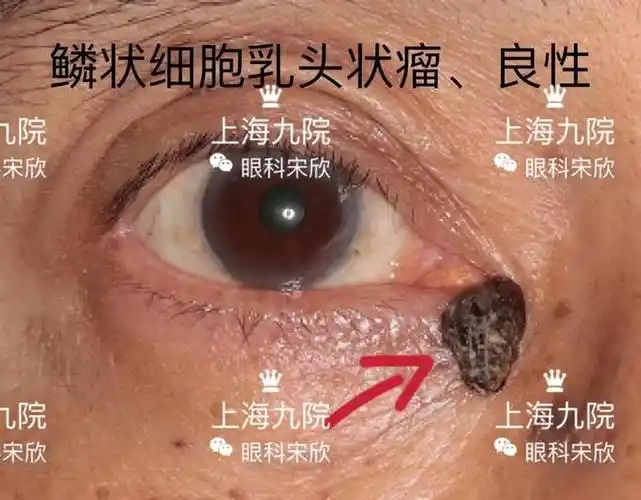 眼皮上奇奇怪怪的疙瘩都是什么常见眼睑肿瘤图片良恶性