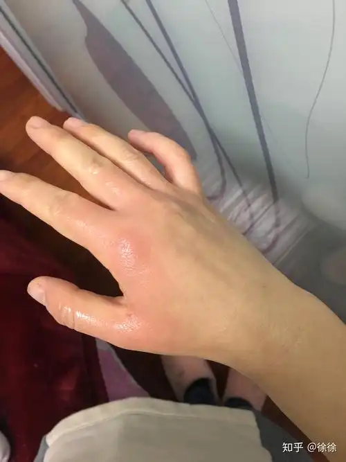 烫伤起的水泡可以戳破吗?