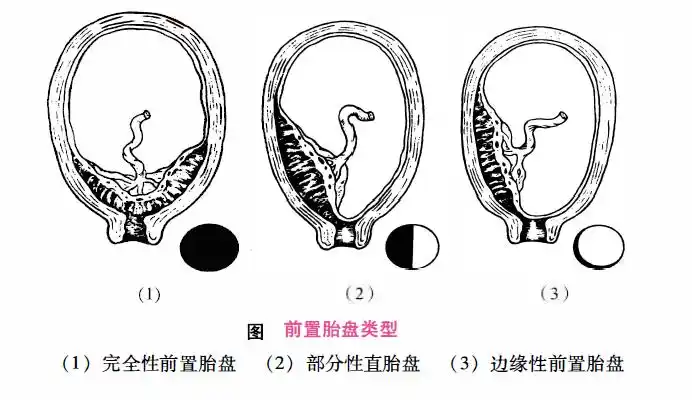 前置胎盘类型