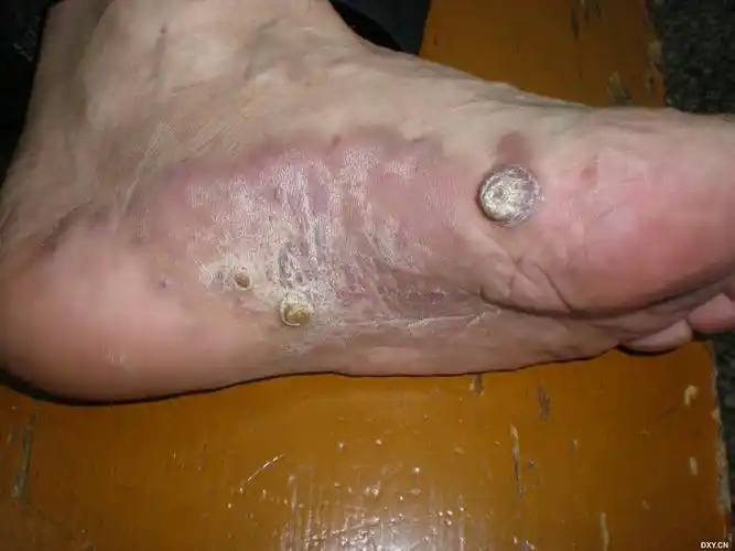 【共享】经典型kaposi肉瘤 - 皮肤与性传播疾病讨论版 -丁香园论坛