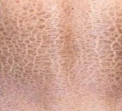 中医如何治疗鱼鳞病