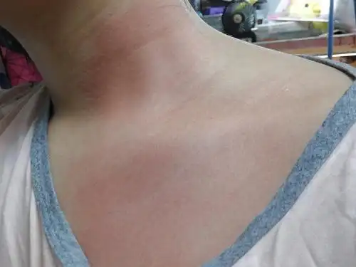 搬宿舍后,脖子红了一大块,是过敏吗