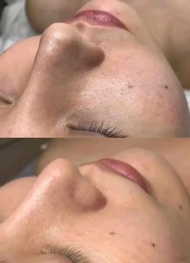 仙女的鼻子怎么可以有黑头粉刺呢?毛孔粗大草莓 - 抖音