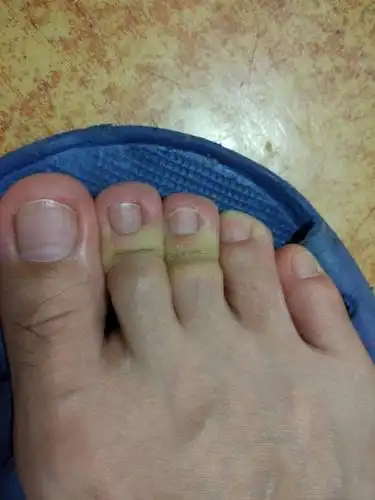 脚中指起水泡之后表皮变硬,而且疼.已经一年了,求原因及恢复的方法.