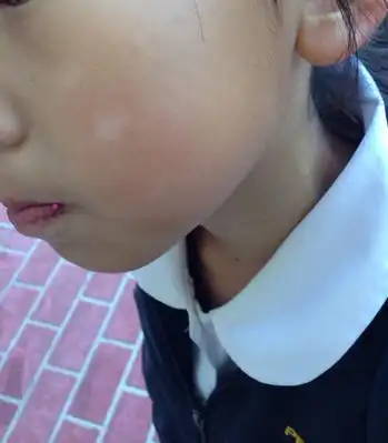 "白色糠疹"科普小课堂