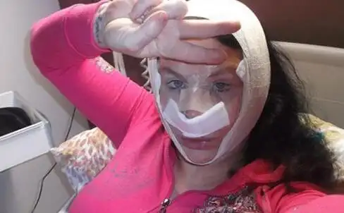 女子18年整容36次 揭整容的后遗症