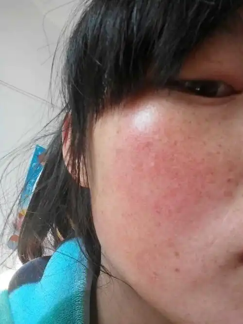 红血丝越来越严重我还怎么办啊