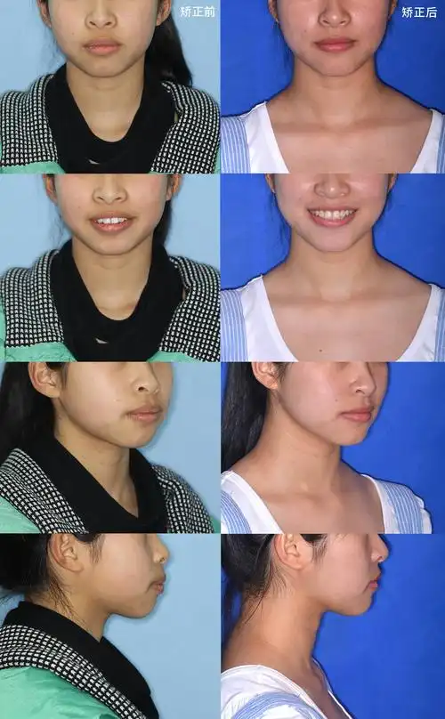 牙齿矫正同样有效!