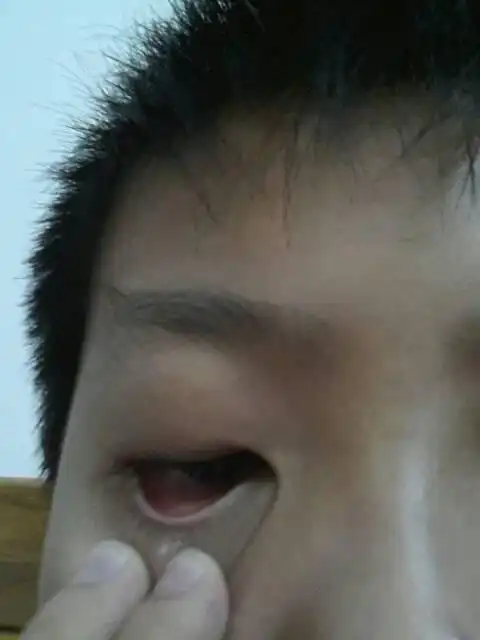 这样的眼睑颜色是不是正常的?