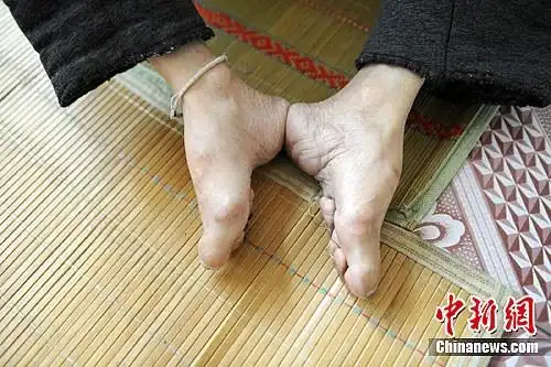 图为13日拍摄田秀芹老人的双脚.张远 摄