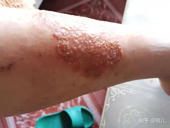 与湿疹的战斗经历