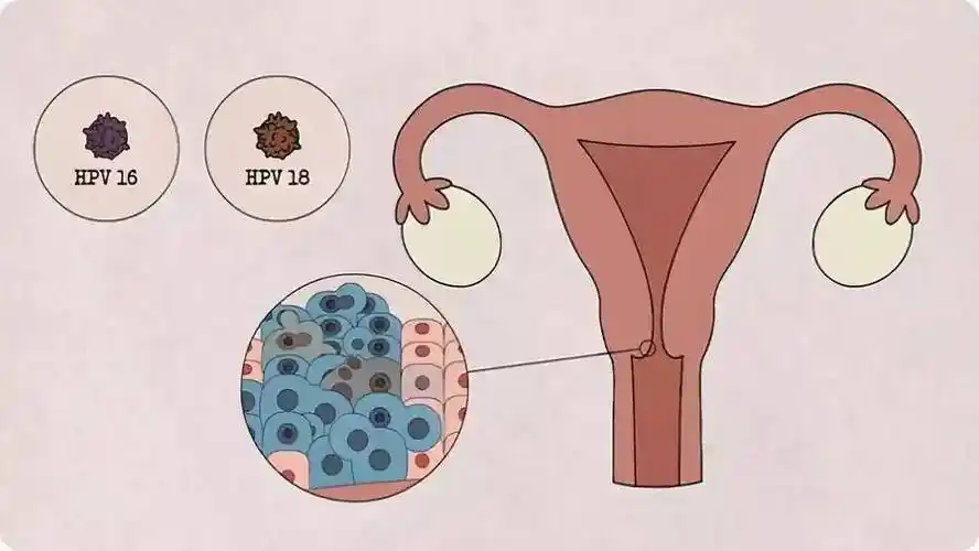 郑州合心医院:女性和男性hpv感染症状有哪些?初期症状有哪些?