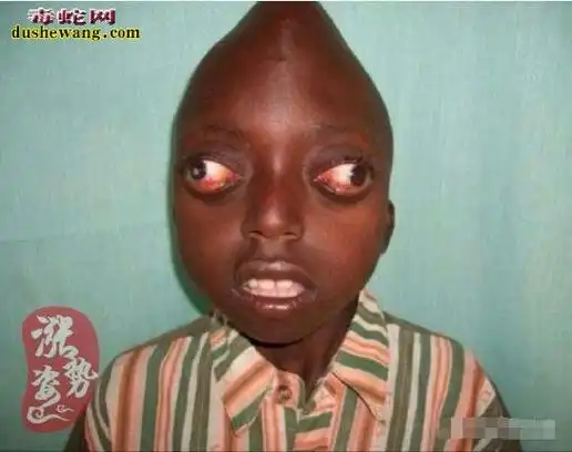 世界上最恐怖的10种人 全球十大恐怖畸形人(真实图片)-今日热搜