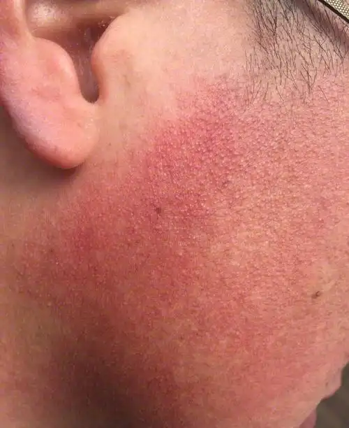 面颈毛囊红斑黑变病-李远宏主任医师-爱问医生