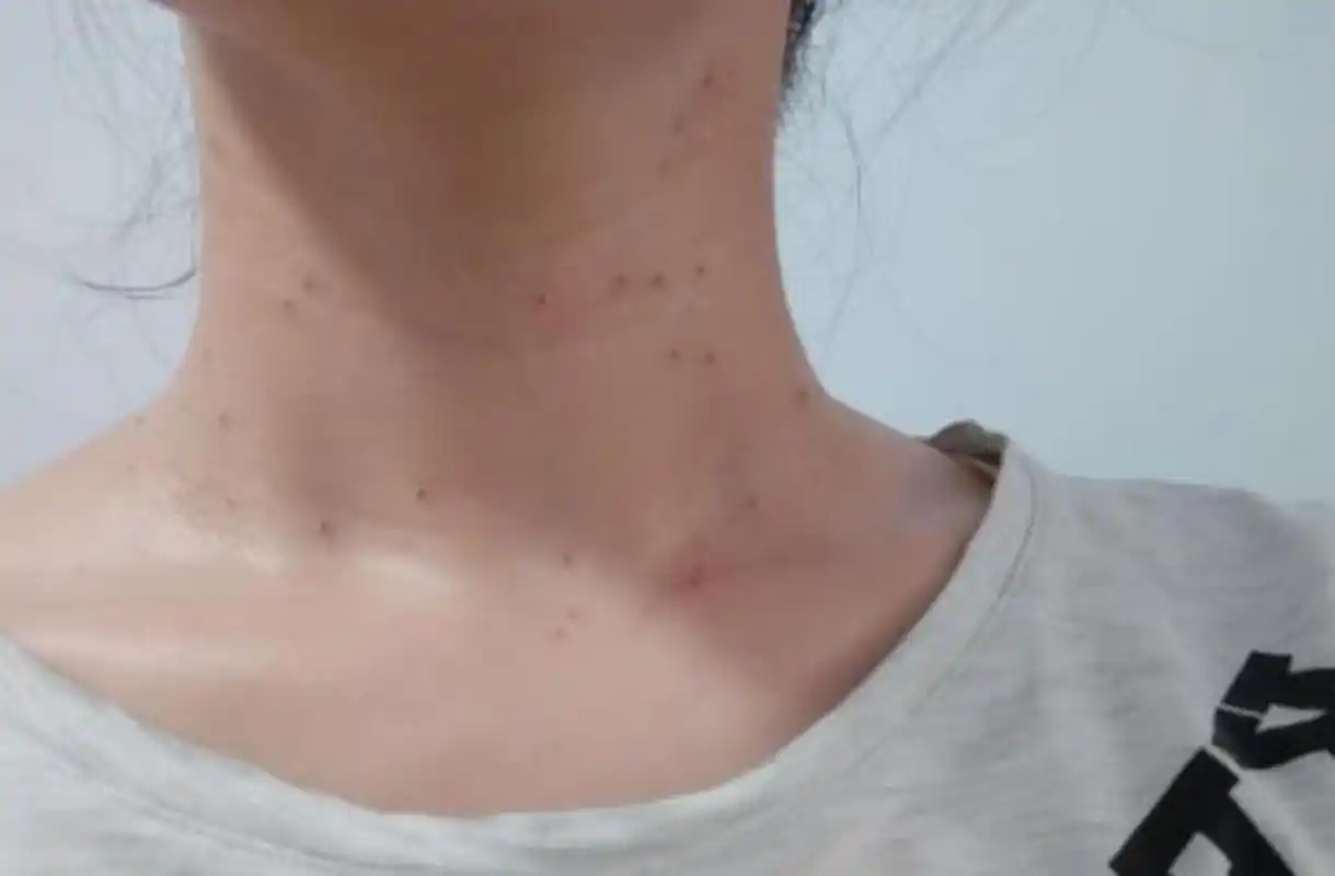 脖子长长了一些小揪揪 这叫丝状疣,是一种病毒感染引起的皮肤病 记住