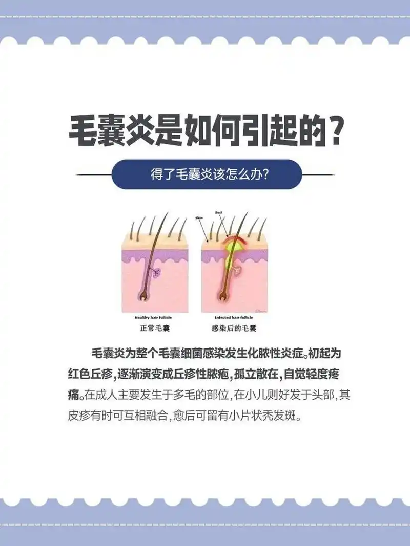 毛囊炎为整个毛囊细菌感染发生化脓性炎症.