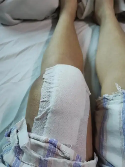 3月30日,医生查房让我主动弯曲腿部,看了我的情况说我不行,要到达90度