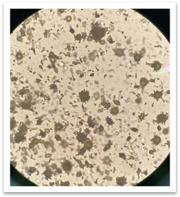 尿液标本中尿酸铵结晶