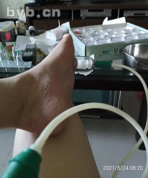 拔罐治脚气 一罐定乾坤